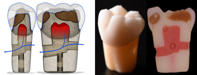 Modèle de dent en 3D pour des travaux pratiques de dentisterie restauratrice